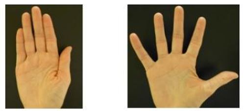Hand-oedeem-1.jpg
