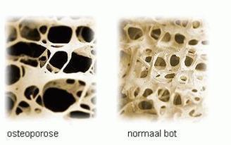 Osteoporose.jpg