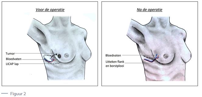 Oncoplastiche-borstrecontructie-2.jpg