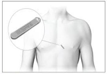 2-implantatie-hartritmemonitor-ILR-2.jpg