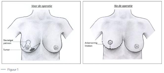 Oncoplastiche-borstrecontructie-1.jpg