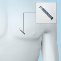 Reveal-implantatie3.jpg