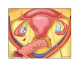 endometriose-figuur-1b.png